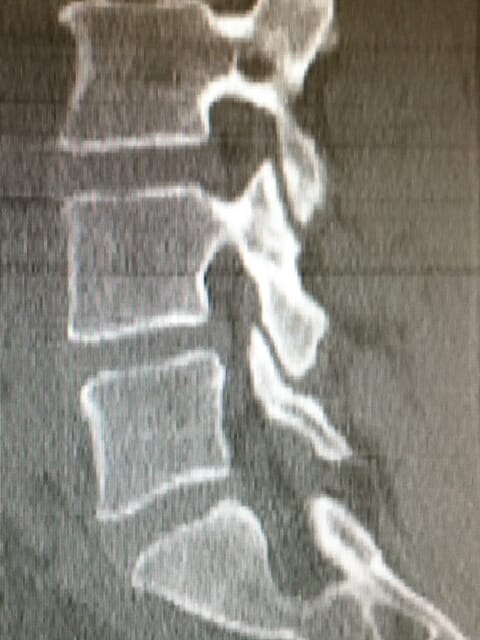 Side x-ray of a spine.